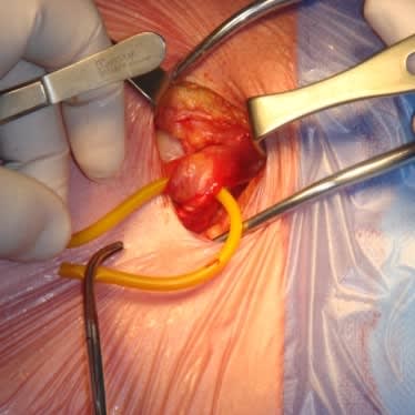 Hernia Surgery