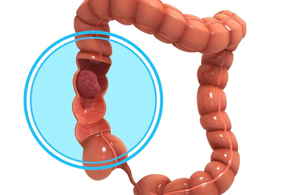 Colon Cancer in India: The Silent Killer You Can Stop Early
