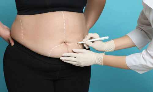 Enhancing Patient Recovery with Laparoscopic Bariatric Surgery