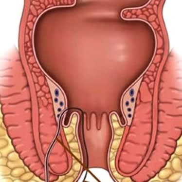 Fistula Surgery