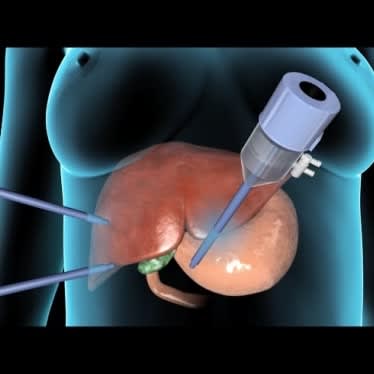Gall Bladder Surgery