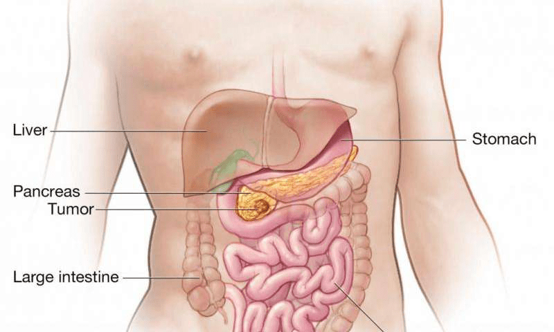 Pancreatic Surgery in Hyderabad