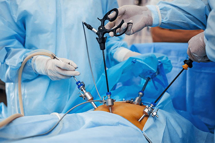 Laparosocpic GI Surgery in Hyderabad
