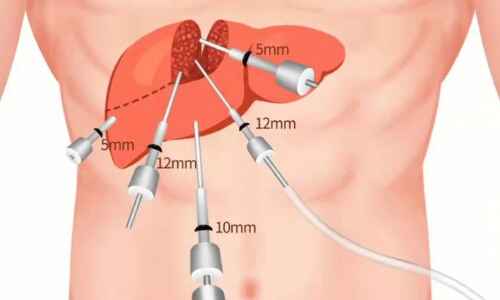 Laparoscopic Liver Resection: Advantages and Applications