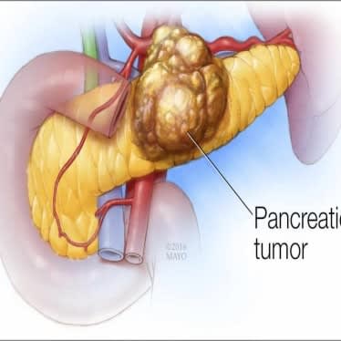 Hepatobiliary Pancreatic Surgeries