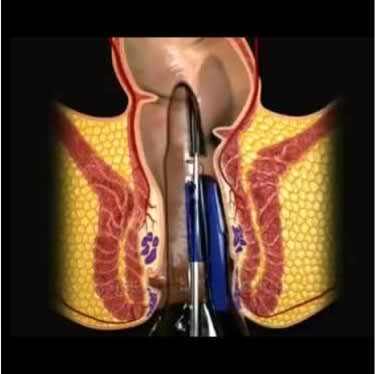 Piles Surgery