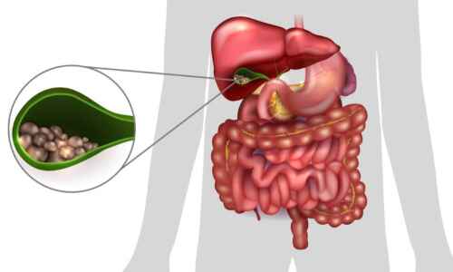 Unveiling the Essentials of Gallbladder Surgery: A Path to Health and Relief
