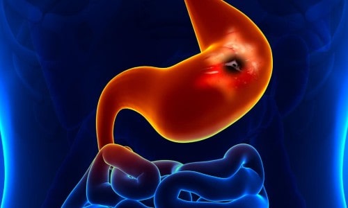 Why Stomach Ulcer Won’t Heal!